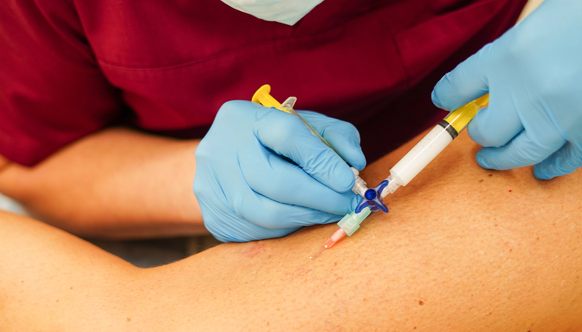 AMELİYATSIZ VARİS TEDAVİSİ