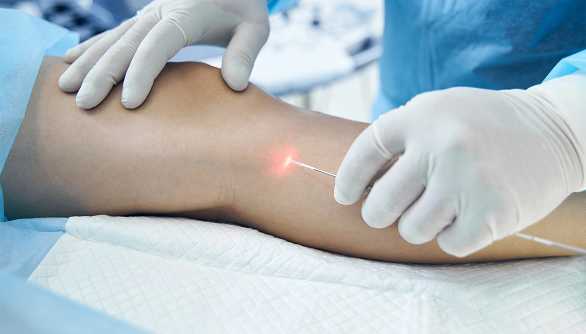 LAZERLE VARİS TEDAVİSİ