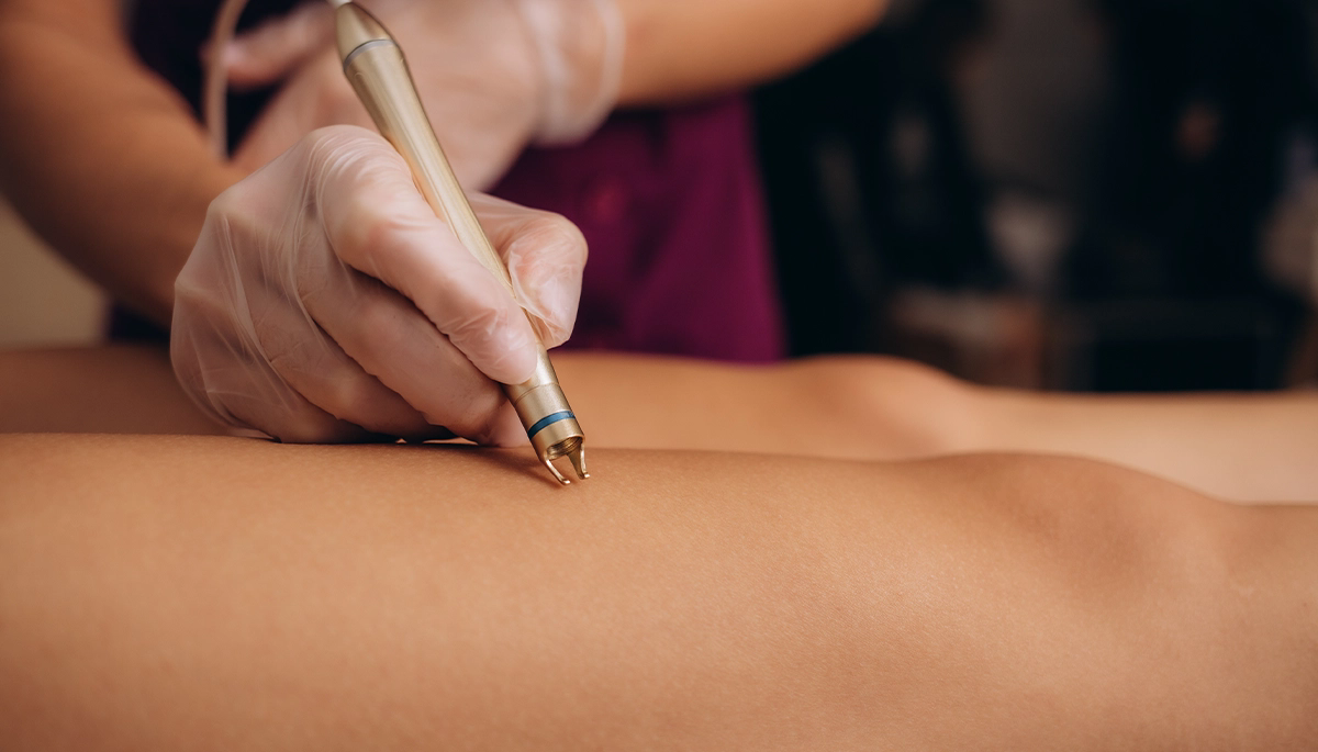 RADYOFREKANS RF İLE VARİS TEDAVİSİ