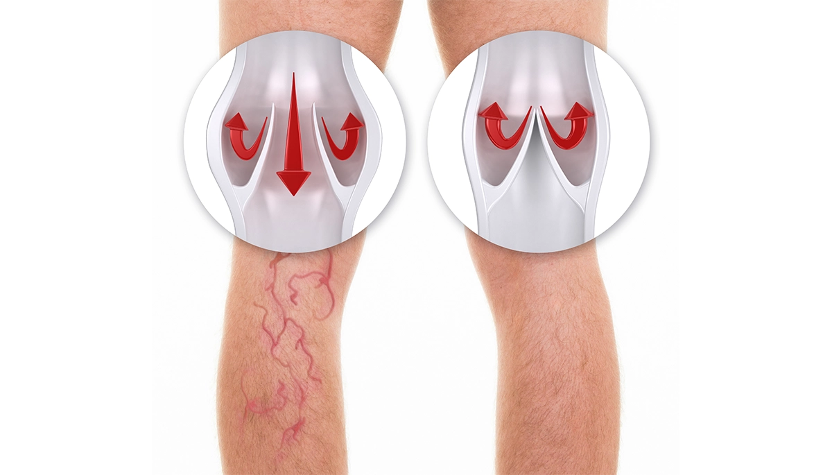 Varis Neden Olur Varise Yol Açan Faktörler