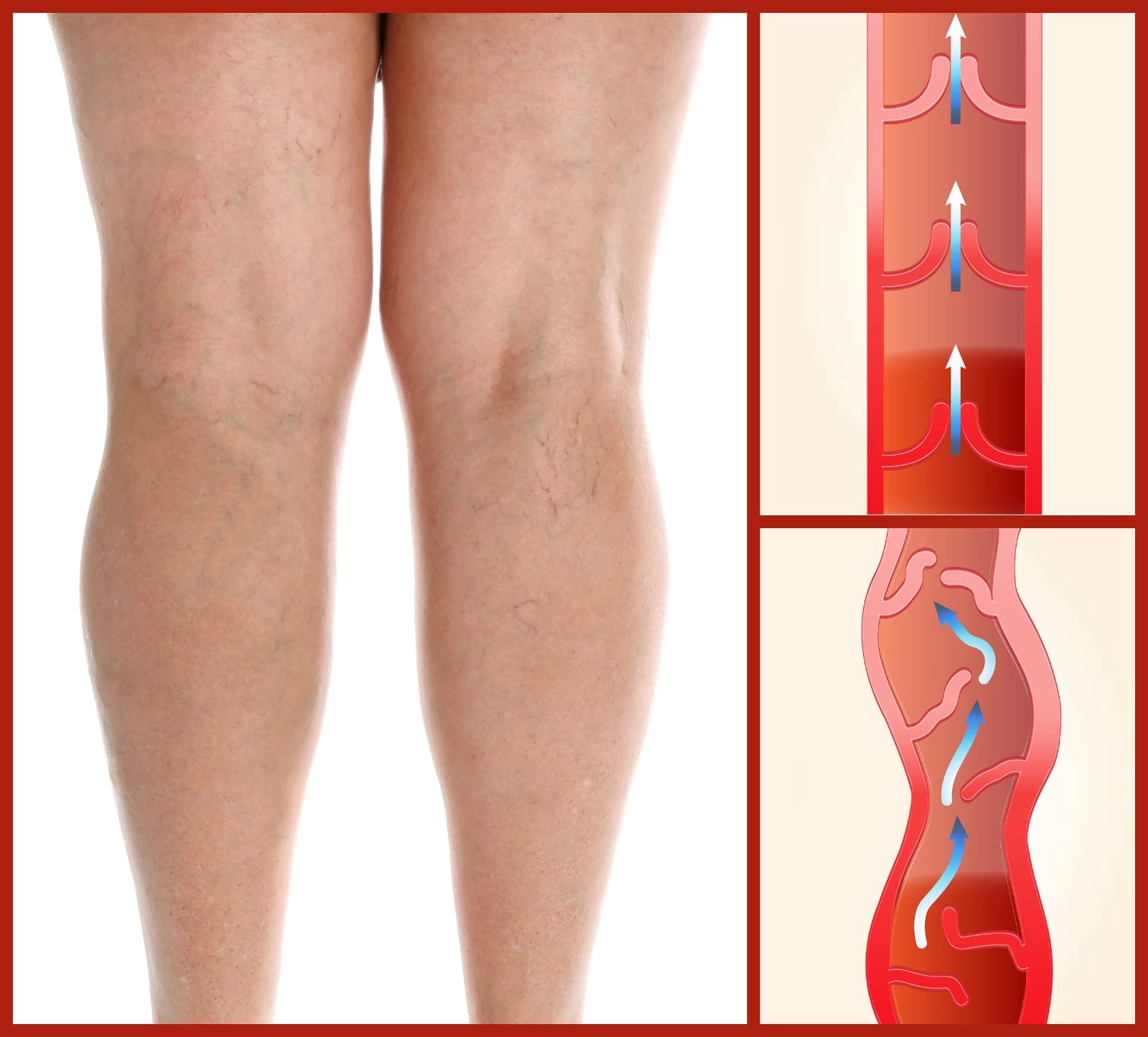 Varis Tedavisinden Önce En Sık Yapılan Hatalar